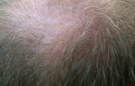 השתלת שיער – השאלה היא הכמות