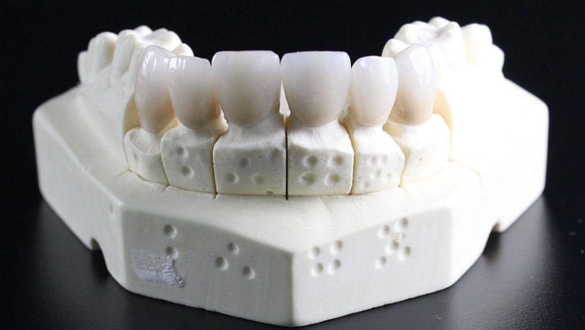 השתלת שיניים ביום אחד – איך זה עובד?